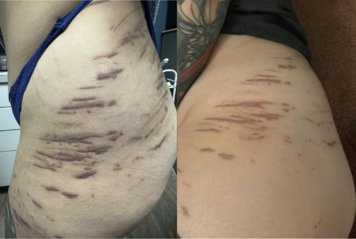 scars show before and after 10 weeks of red light therapy